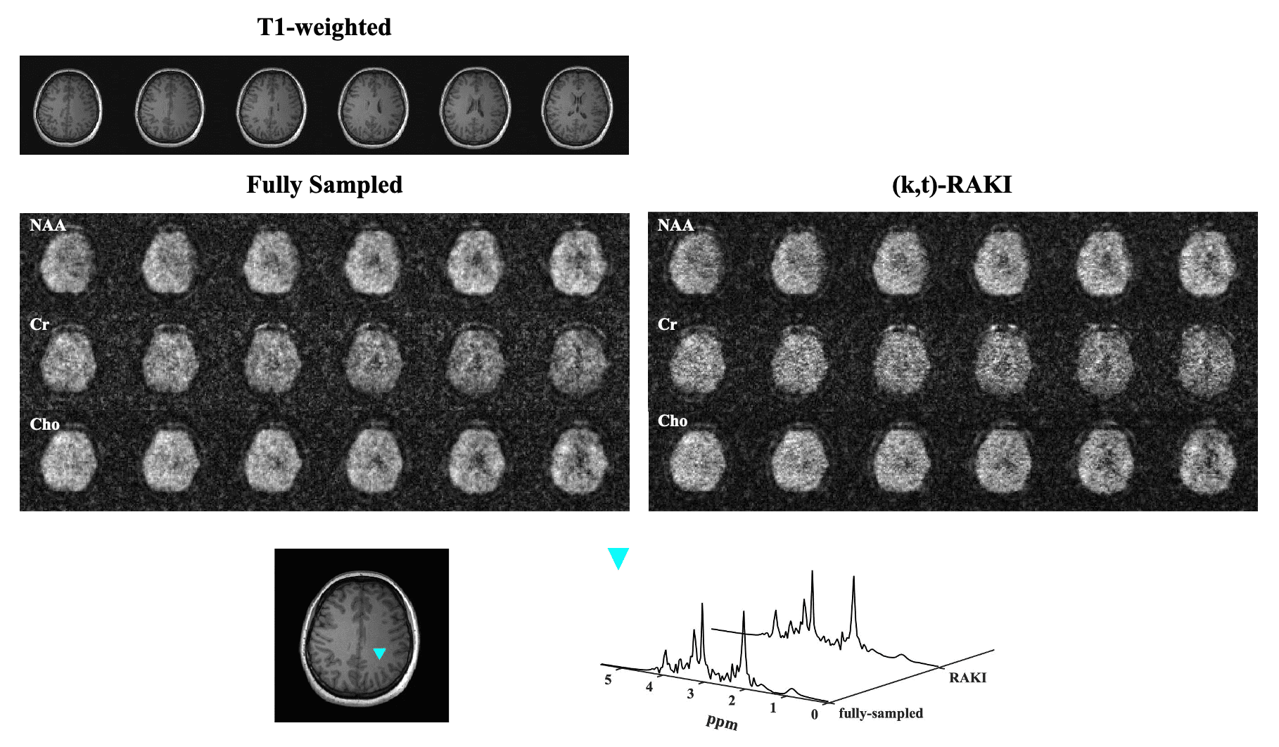 A (k,t)-RAKI Method for Interpolating Sparse Data in Accelerated MRSI Acquisitions